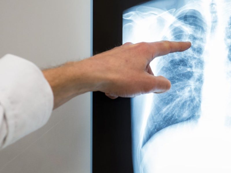 Случаите на туберкулоза в Малайзия надхвърлят 3000, здравното министерство сигнализира за рискове